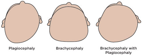 Flattened Head Syndrome or Positional Plagiocephaly -